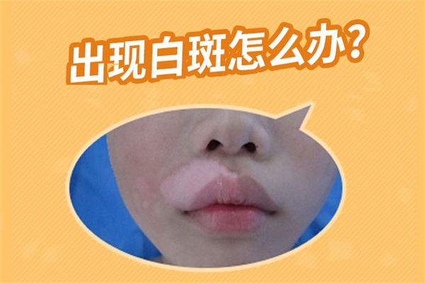 懷孕期間得了白癜風,懷孕期間得了白癜風怎么治